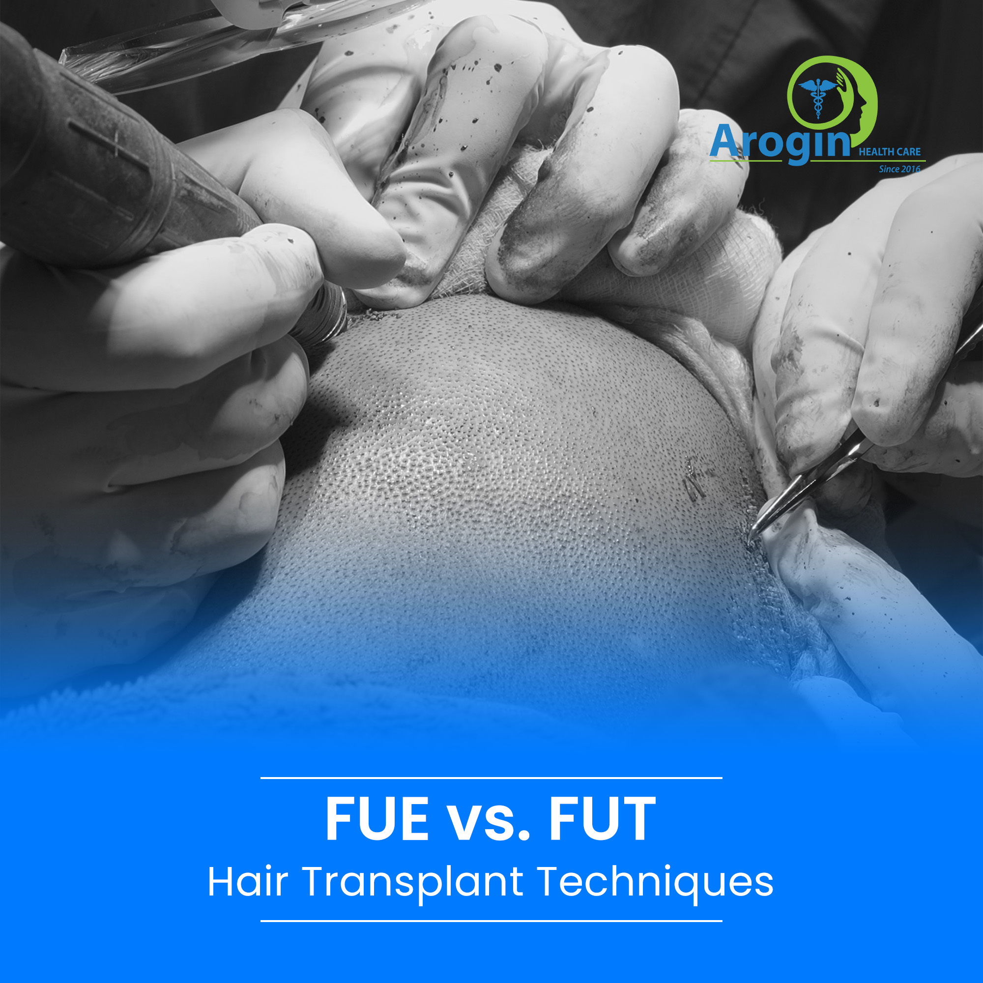 FUE vs. FUT Hair Transplant: Best Hair Loss Solution 2025